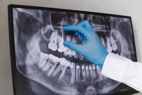 Digital X-ray at Mitcham Central Dental – precise diagnostic imaging