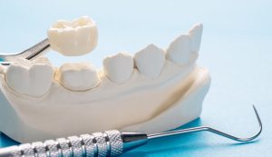 Dental crown treatment – when do you need a crown? Mitcham Central Dental